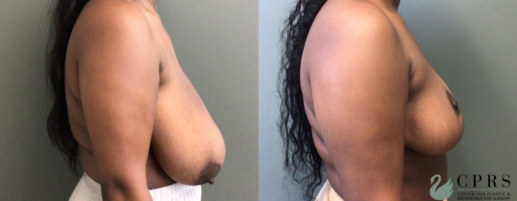Before and after Breast Reduction case 19021 - Angle 2