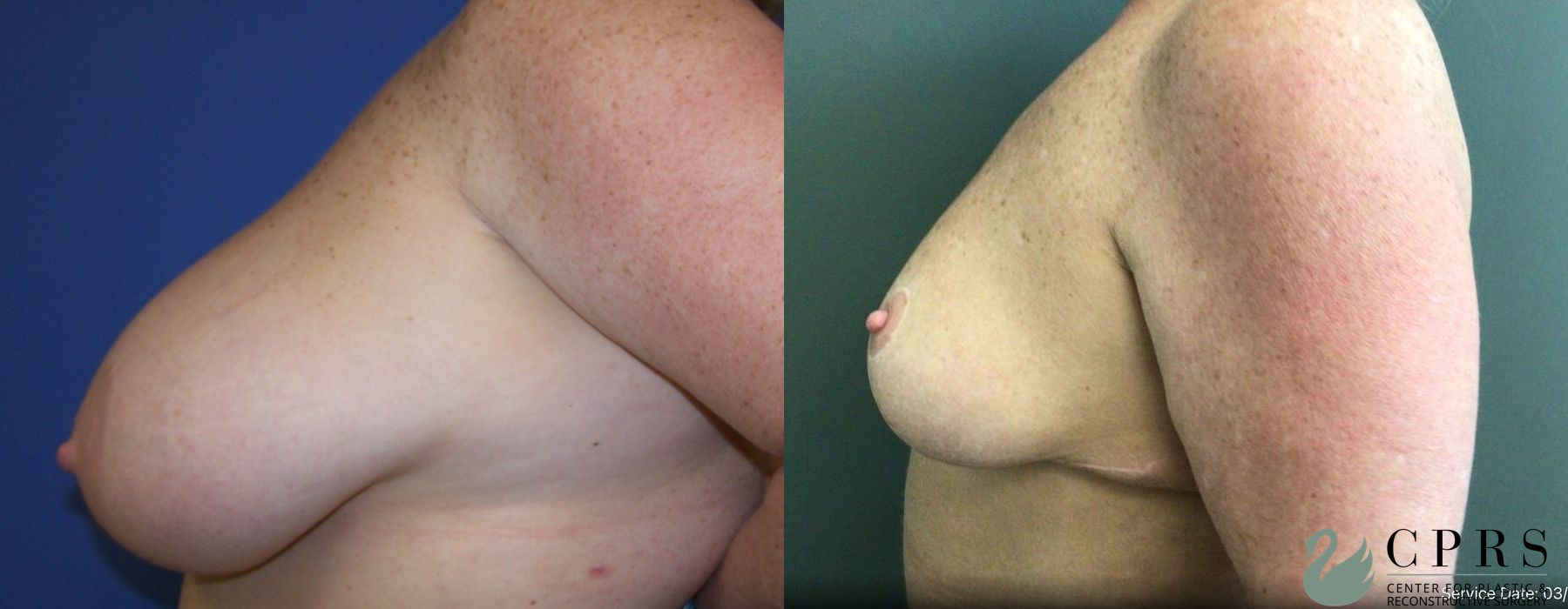 Before and after Breast Reduction case 19116 - Angle 2