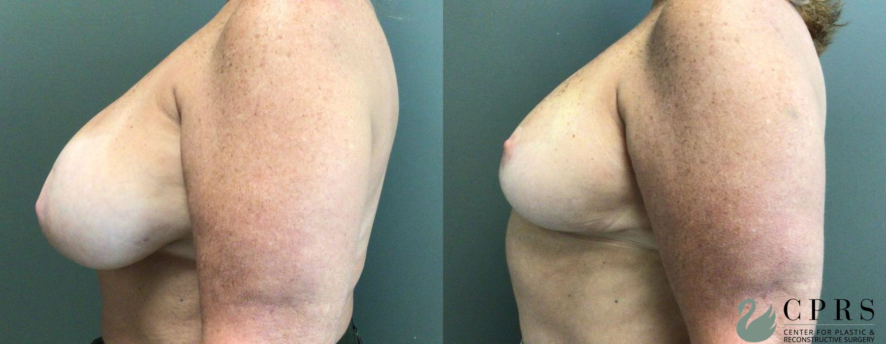 Before and after Breast Reduction case 19010 - Angle 2