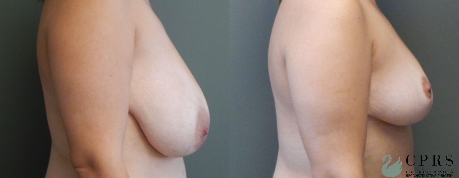 Before and after Breast Reduction case 19005 - Angle 2