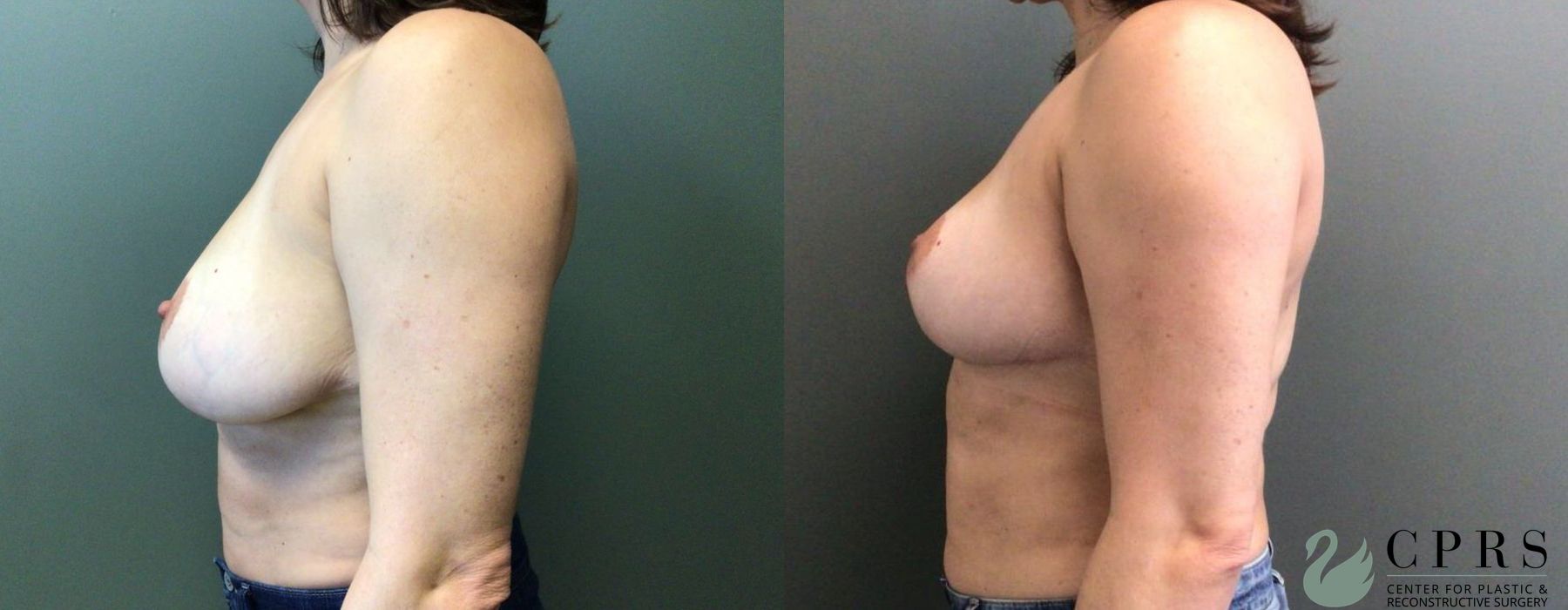 Breast Reduction - Thumbnail 2