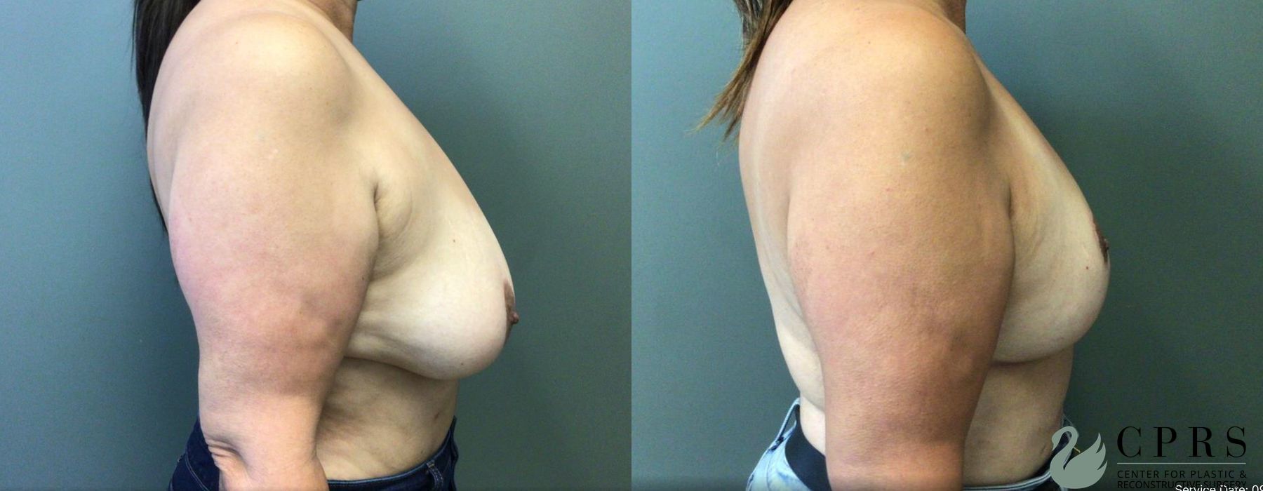 Before and after Breast Reduction case 19022 - Angle 3