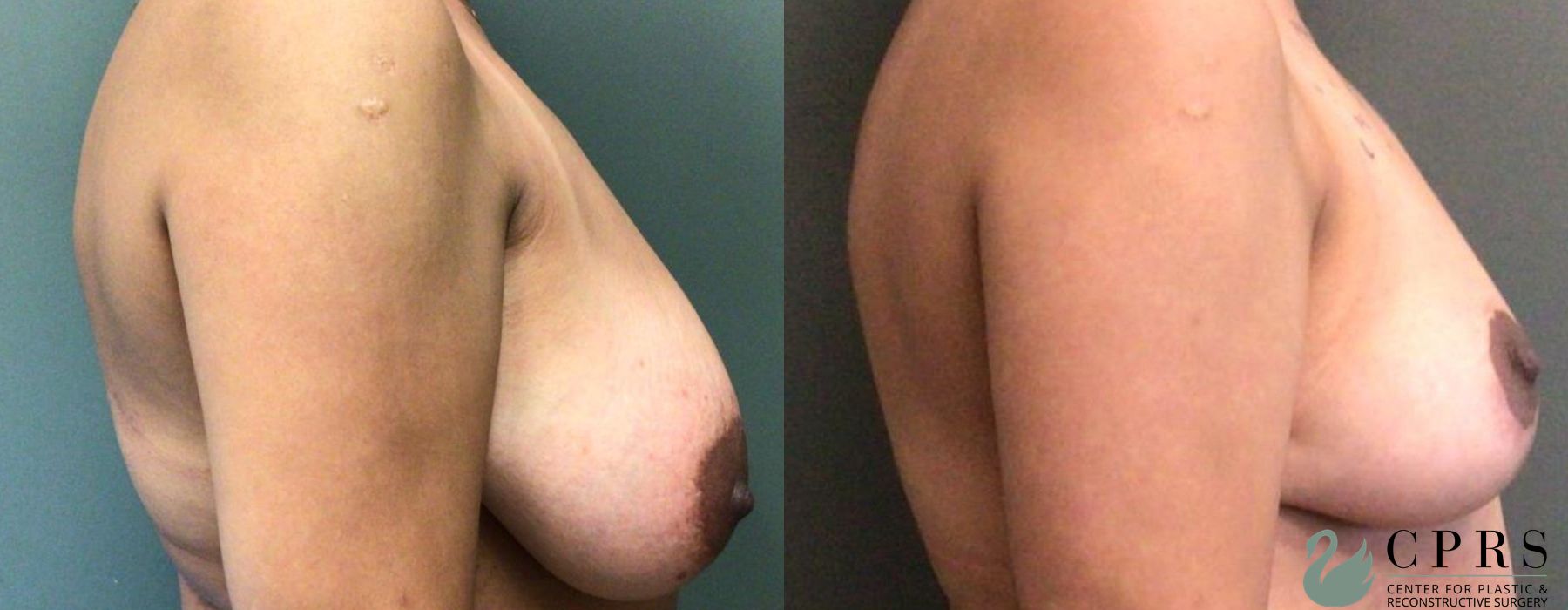 Before and after Breast Reduction case 19120 - Angle 3