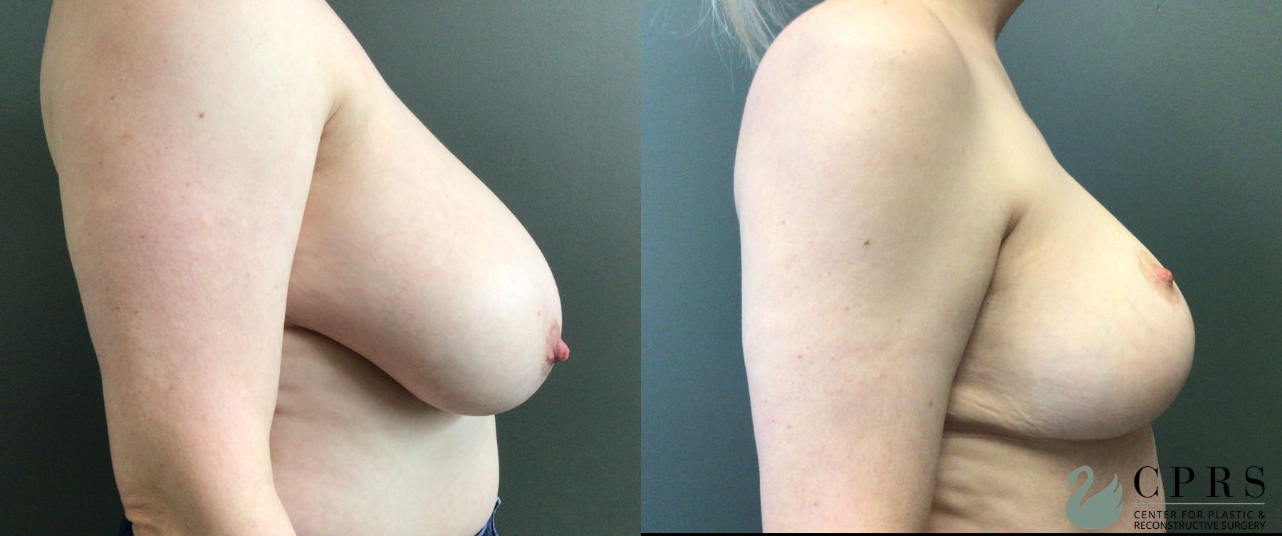 Before and after Breast Reduction case 43676 - Angle 2