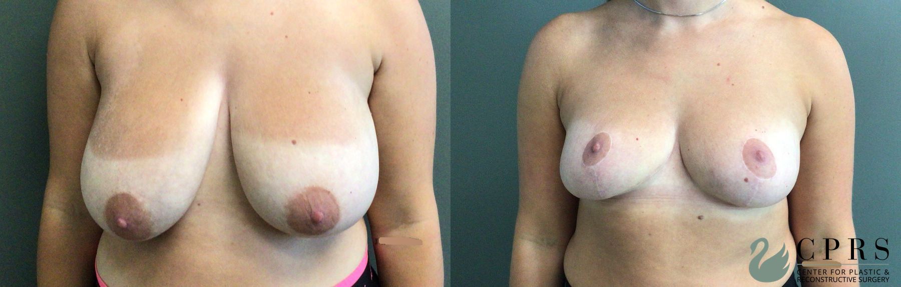 Before and after Breast Reduction case 46139