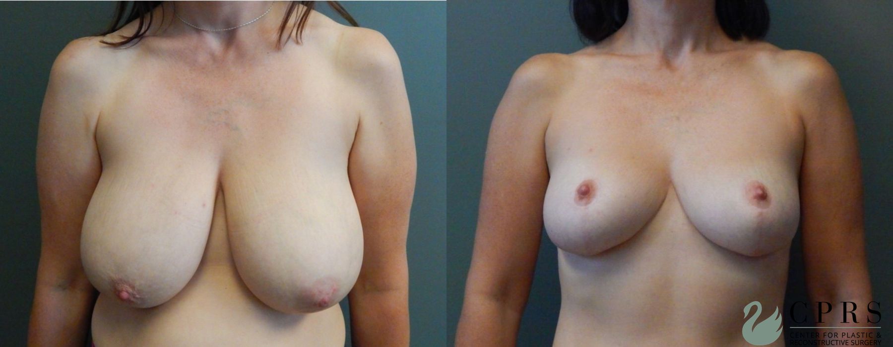 Before and after Breast Reduction case 18926