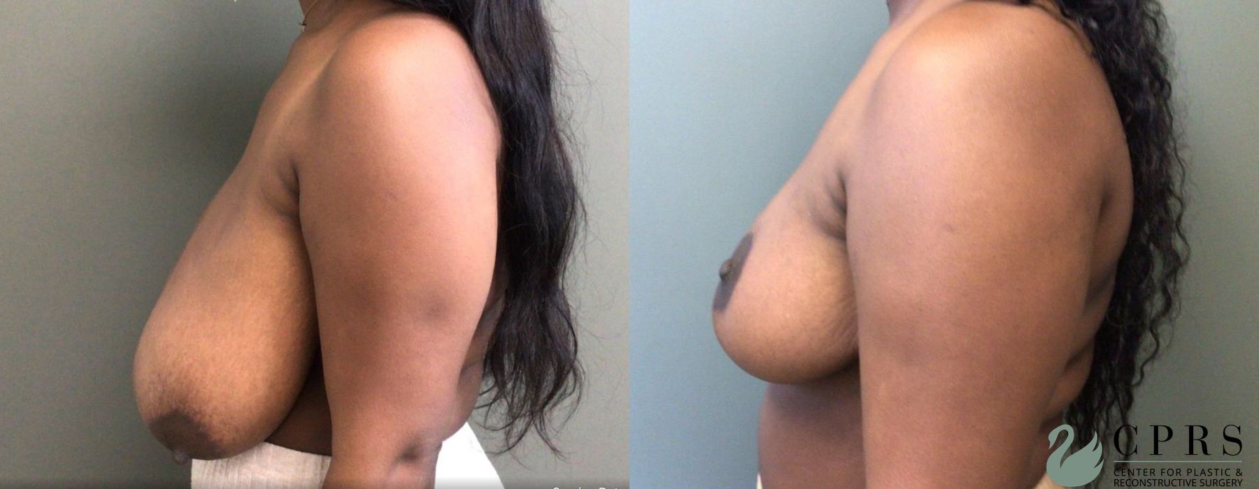 Before and after Breast Reduction case 19021 - Angle 3