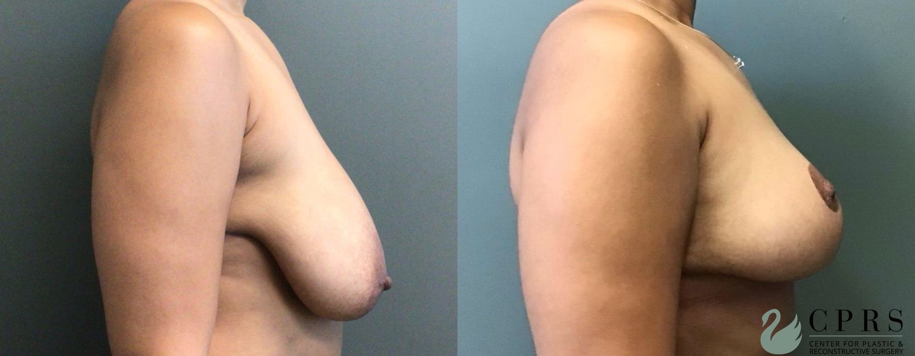 Before and after Breast Reduction case 19193 - Angle 3