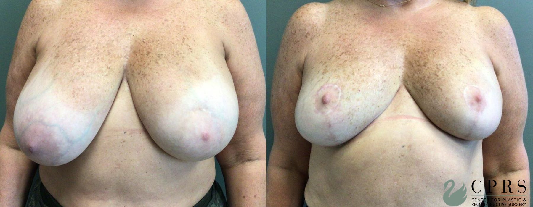 Before and after Breast Reduction case 19010