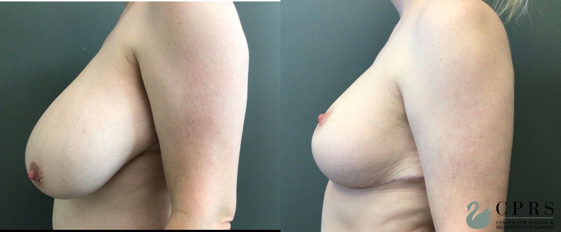 Before and after Breast Reduction case 43676 - Angle 3