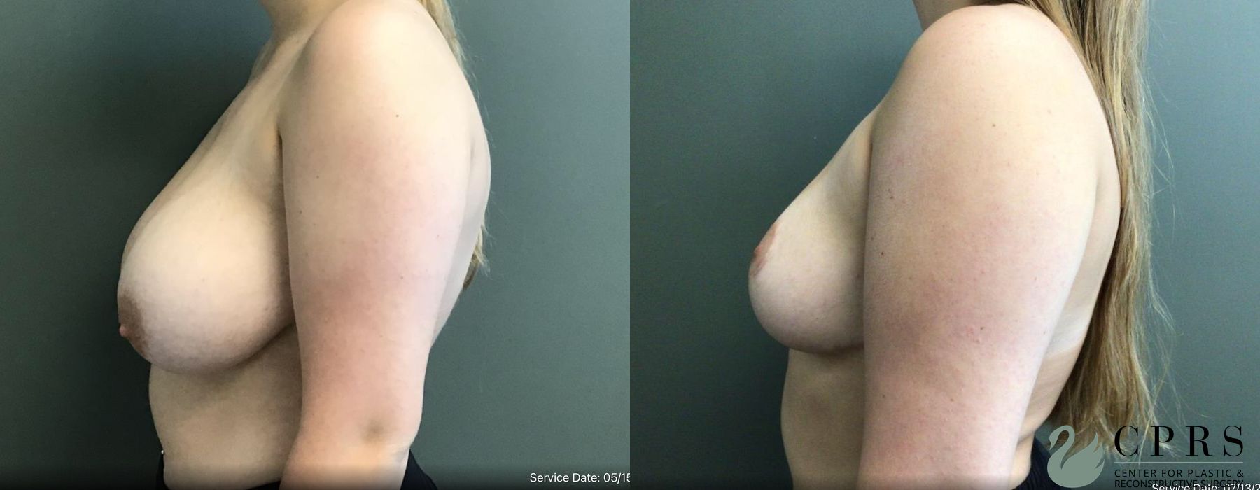 Before and after Breast Reduction case 19129 - Angle 2