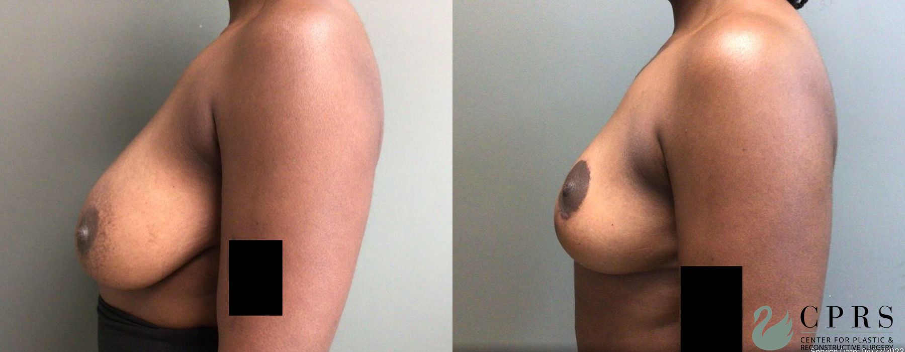 Before and after Breast Reduction case 19138 - Angle 2