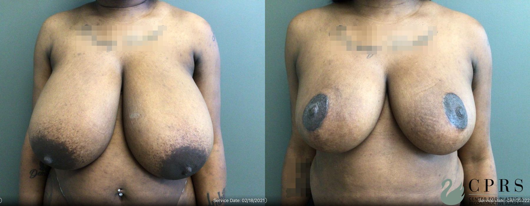 Before and after Breast Reduction case 19121