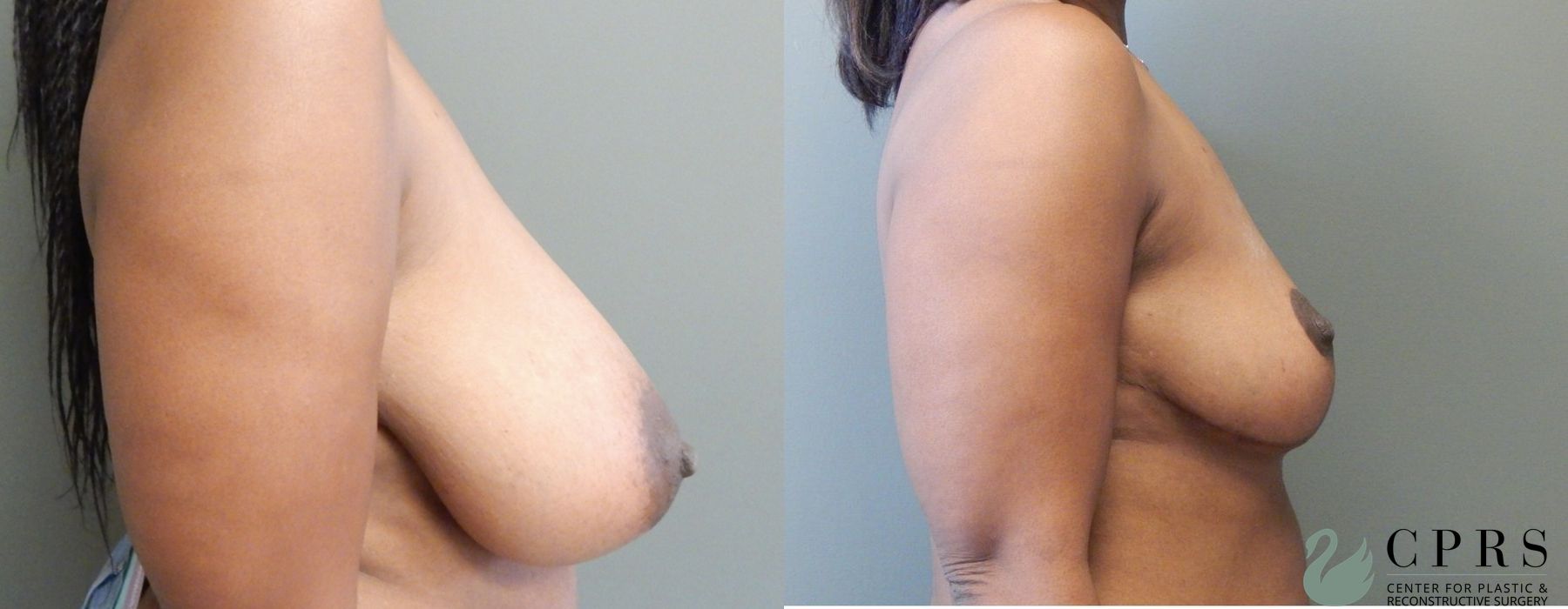 Before and after Breast Reduction case 19008 - Angle 3