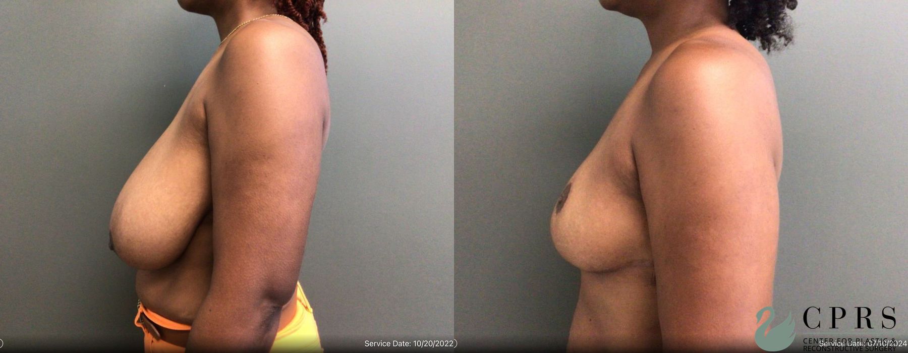 Before and after Breast Reduction case 19192 - Angle 2
