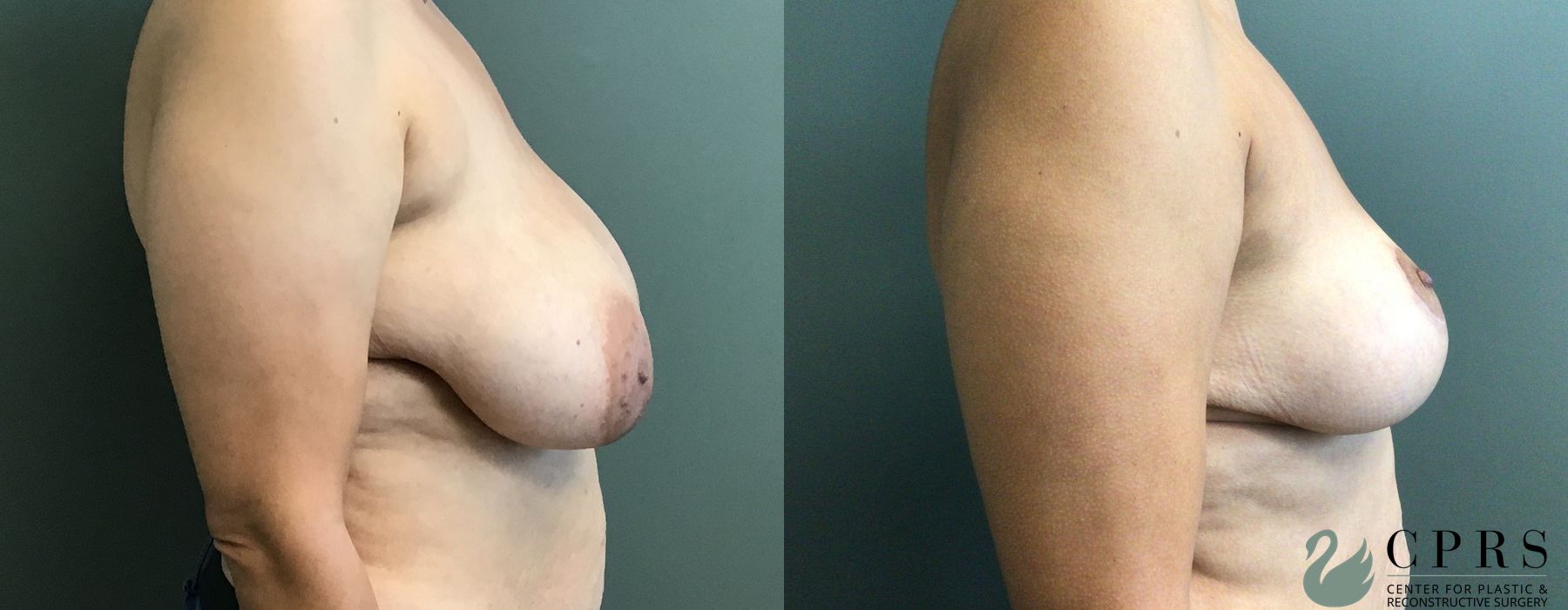 Before and after Breast Reduction case 18987 - Angle 2