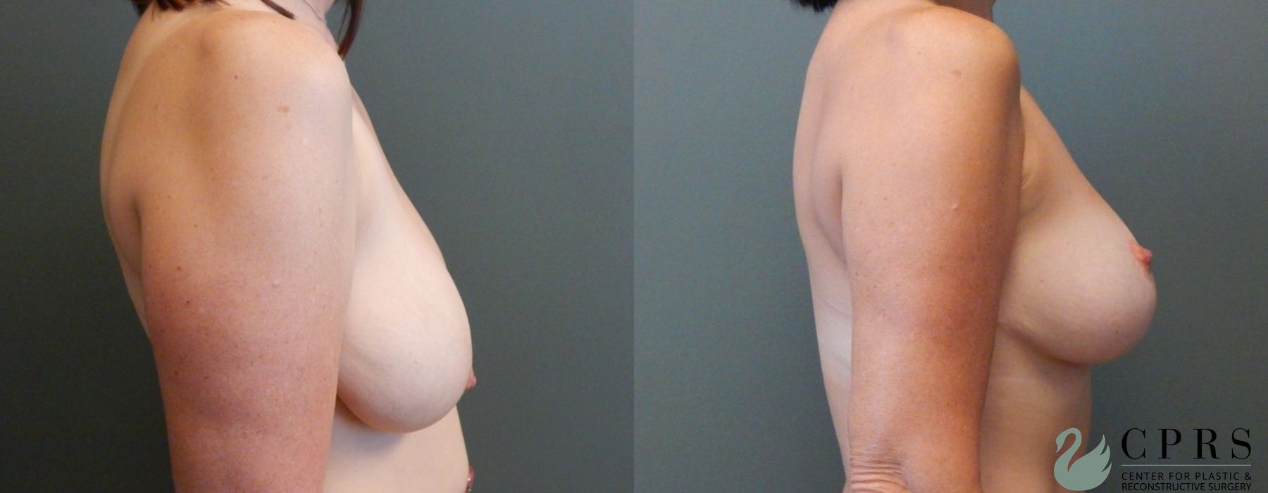 Before and after Breast Reduction case 18926 - Angle 2