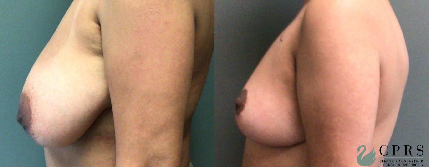 Before and after Breast Reduction case 19120 - Angle 2