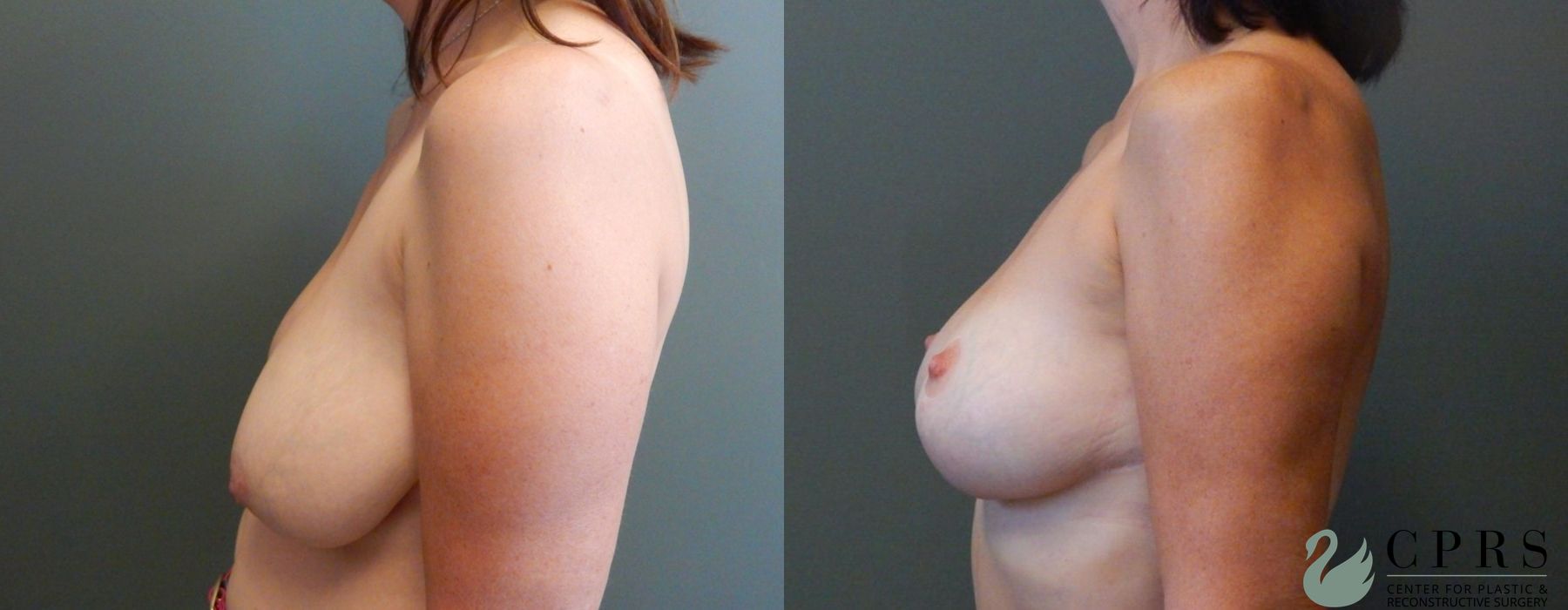 Before and after Breast Reduction case 18926 - Angle 3