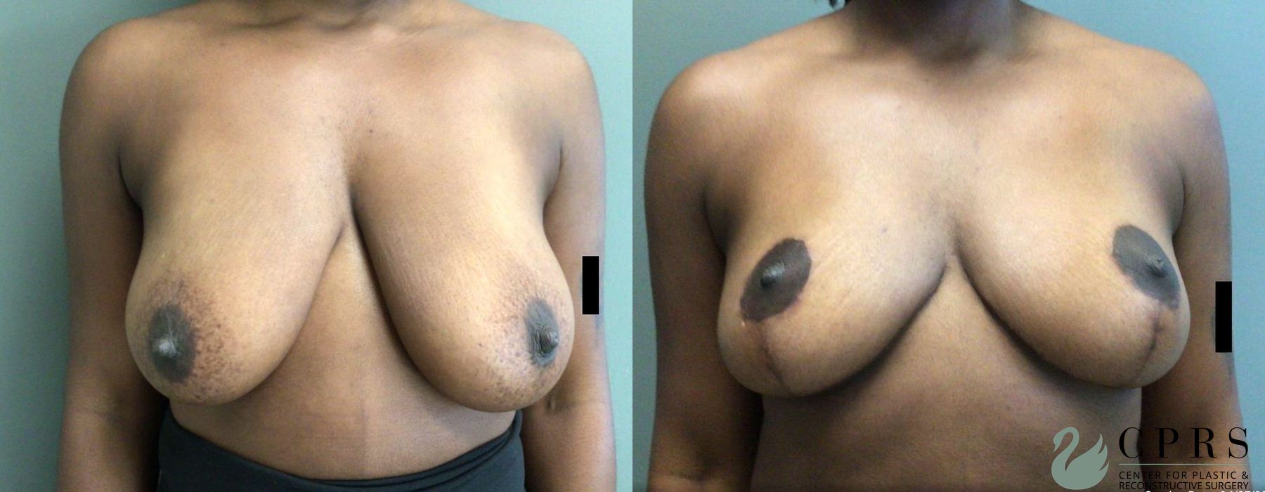Before and after Breast Reduction case 19138