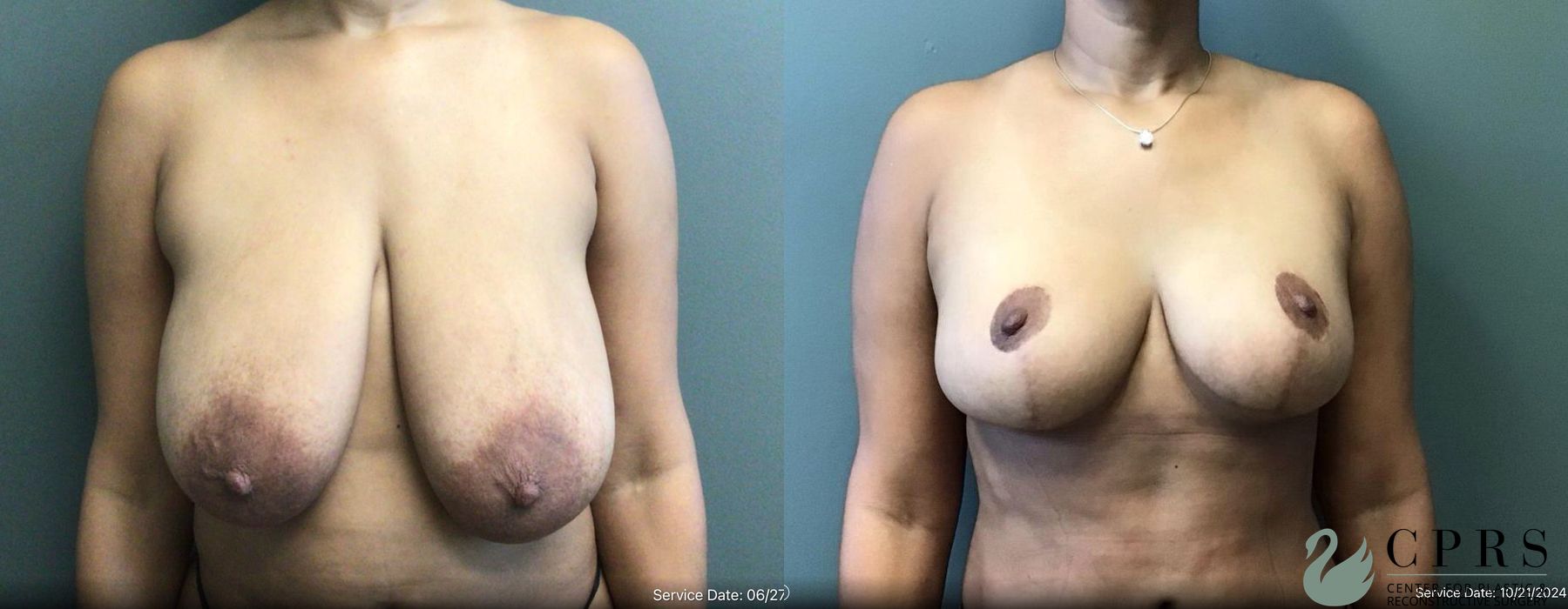Before and after Breast Reduction case 19193
