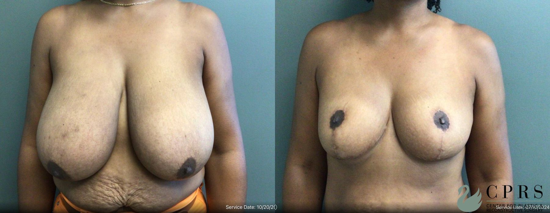Before and after Breast Reduction case 19192