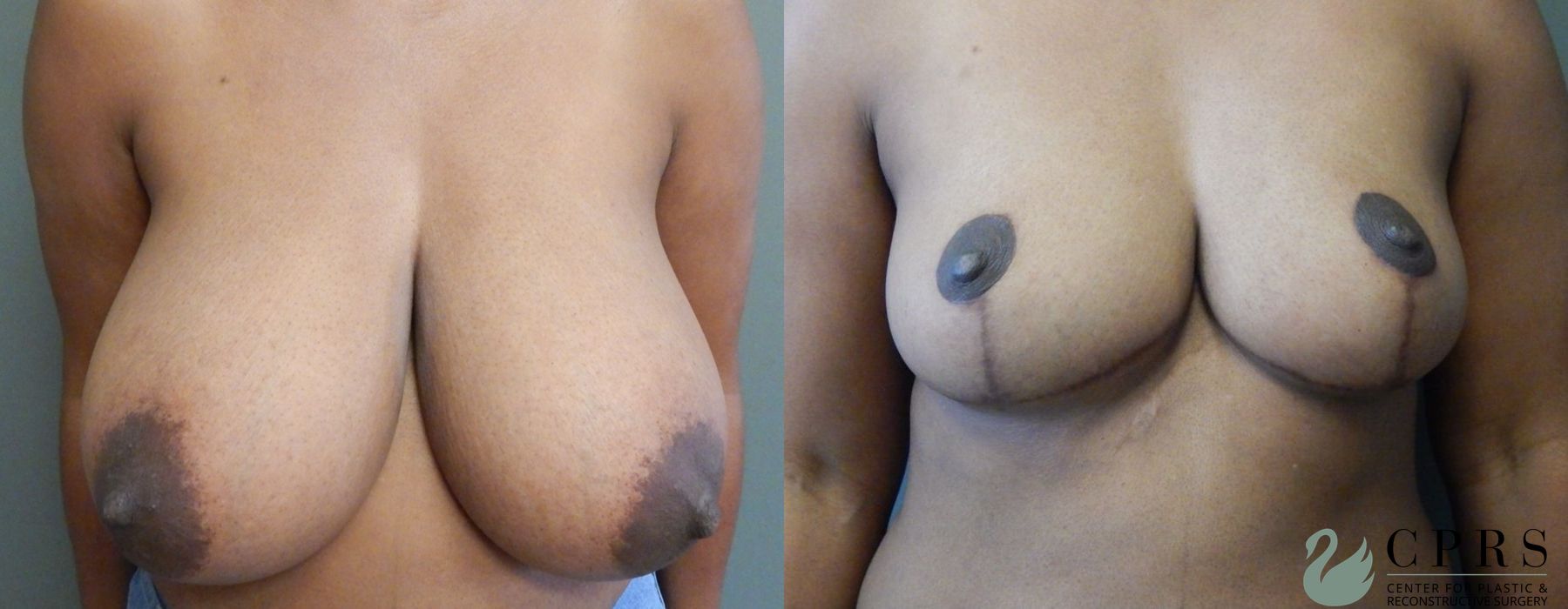 Before and after Breast Reduction case 19008
