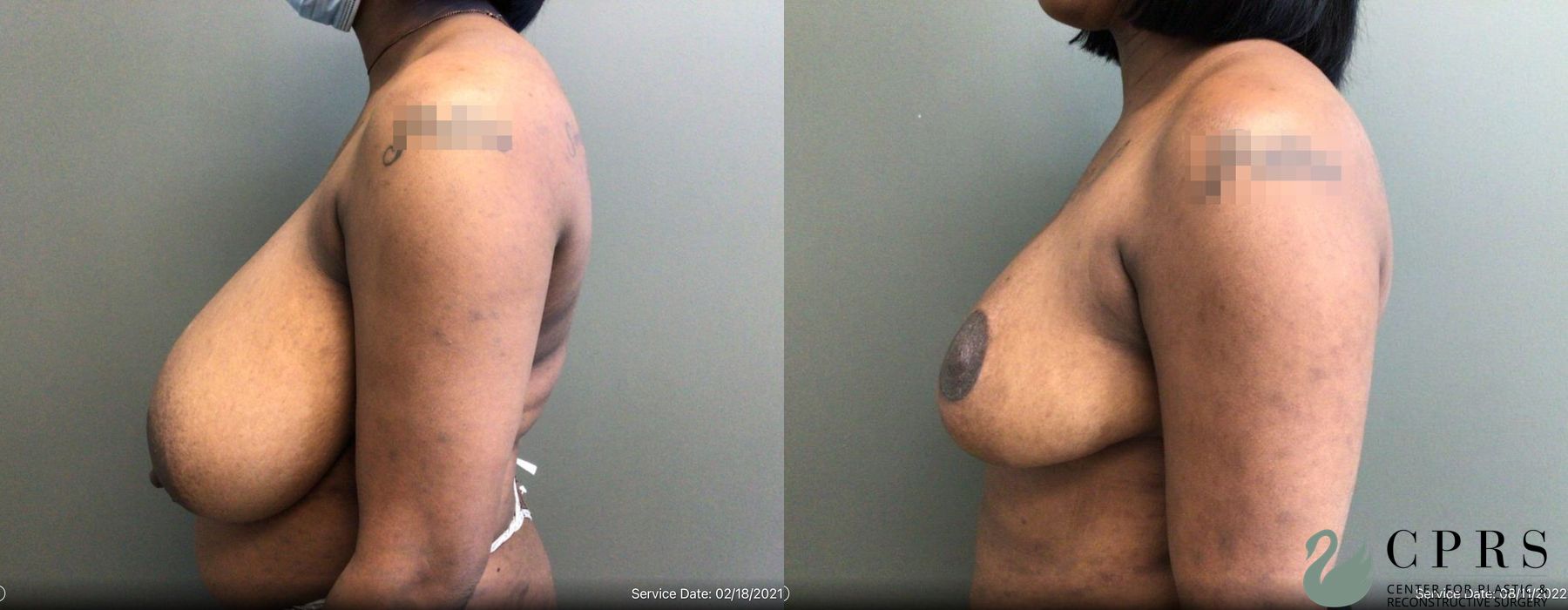 Before and after Breast Reduction case 19121 - Angle 2