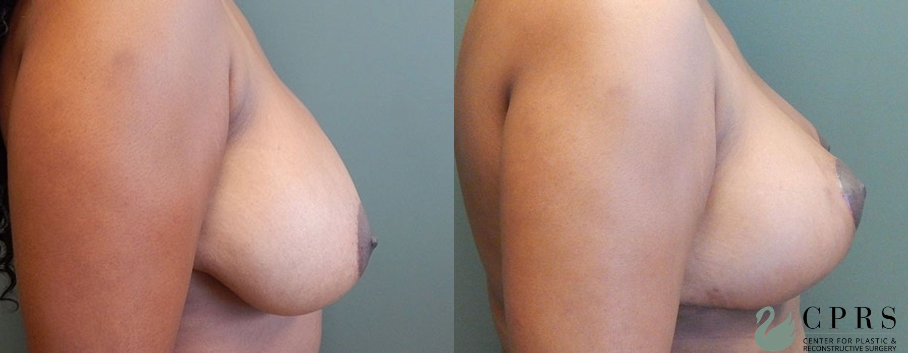 Before and after Breast Reduction case 18982 - Angle 3