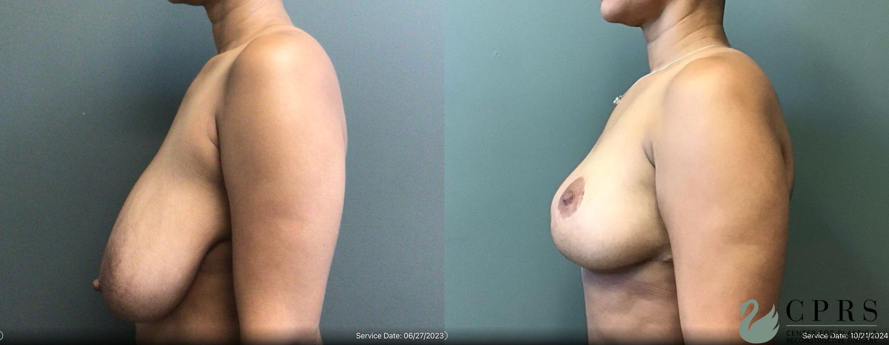 Before and after Breast Reduction case 19193 - Angle 2