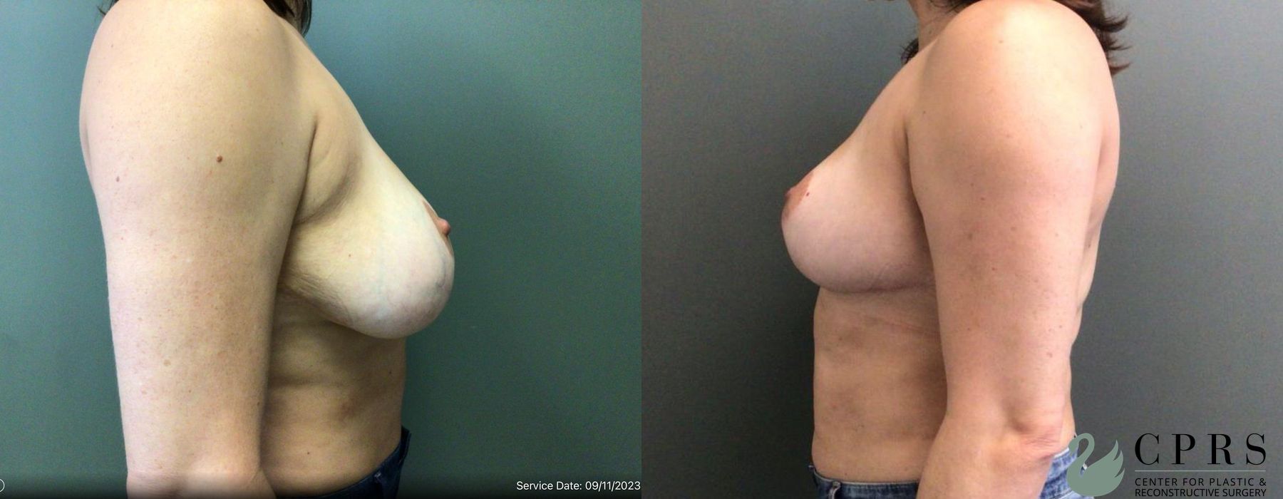 Breast Reduction - Thumbnail 3