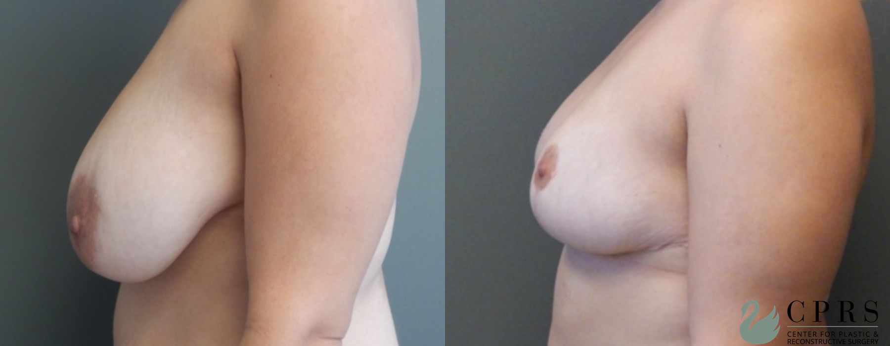 Before and after Breast Reduction case 19005 - Angle 3