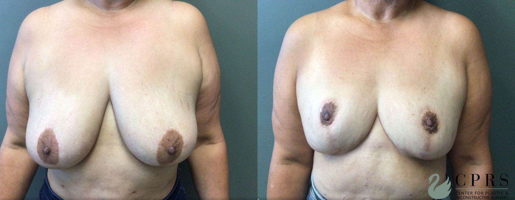 Before and after Breast Reduction case 19022