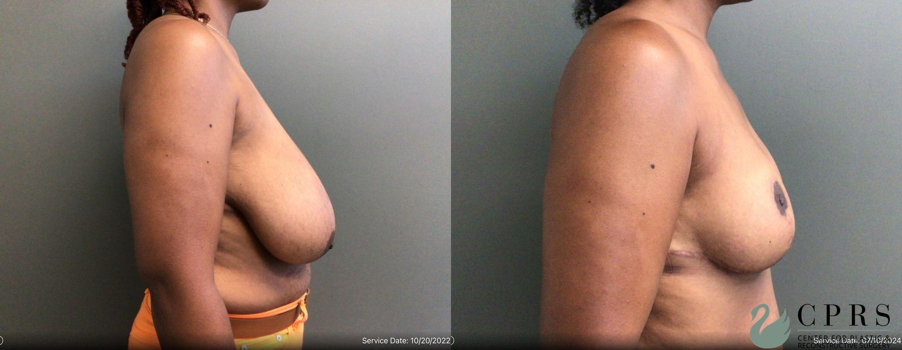 Before and after Breast Reduction case 19192 - Angle 3