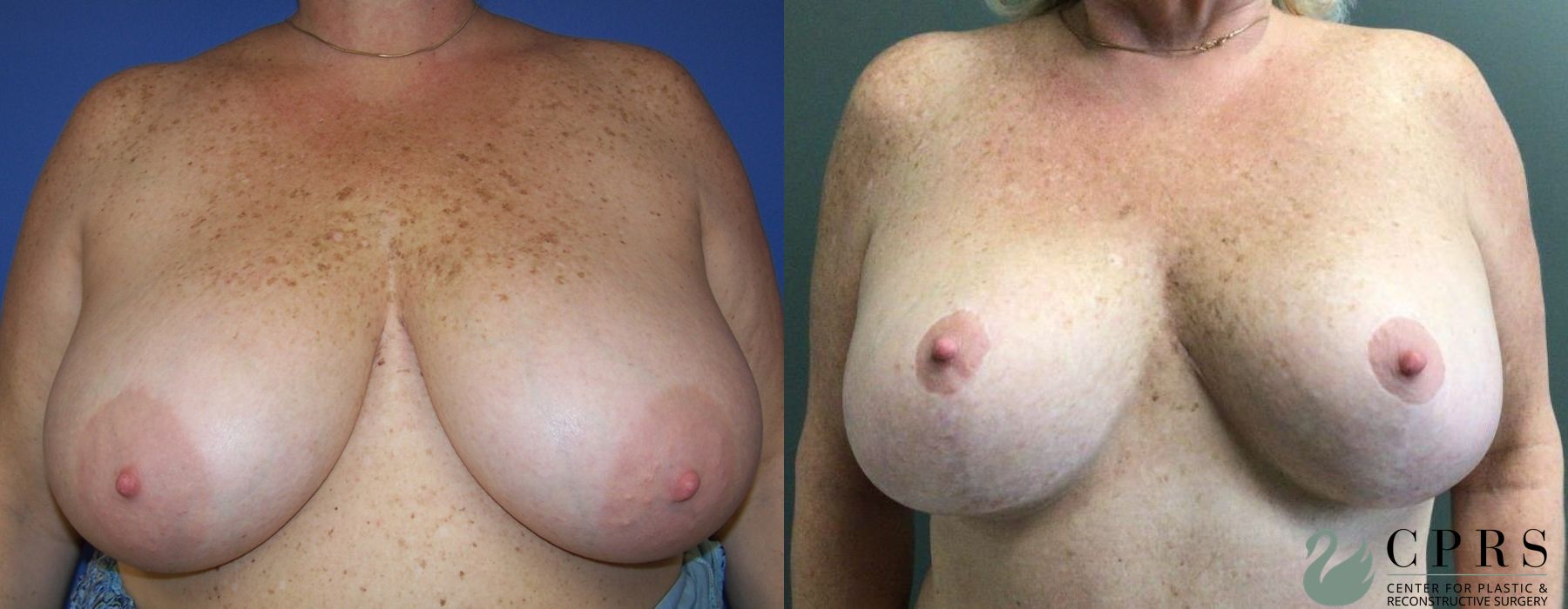 Before and after Breast Reduction case 19116