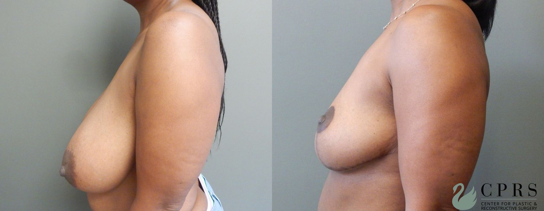 Before and after Breast Reduction case 19008 - Angle 2