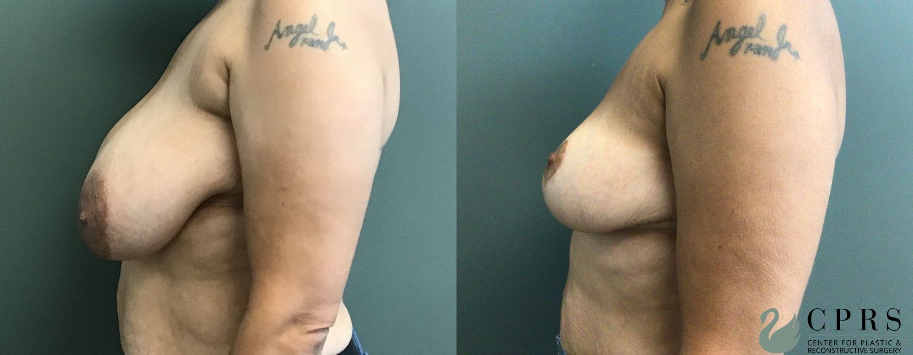 Before and after Breast Reduction case 18987 - Angle 3
