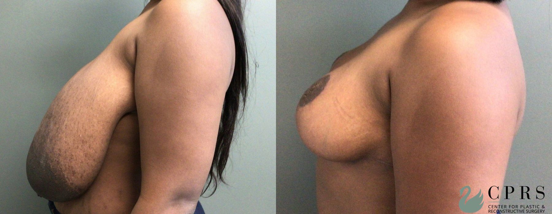 Breast Reduction - Thumbnail 2