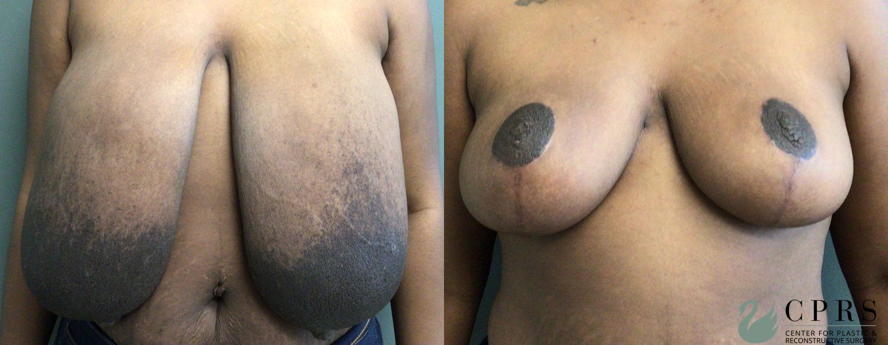 Breast Reduction - Case 239678
