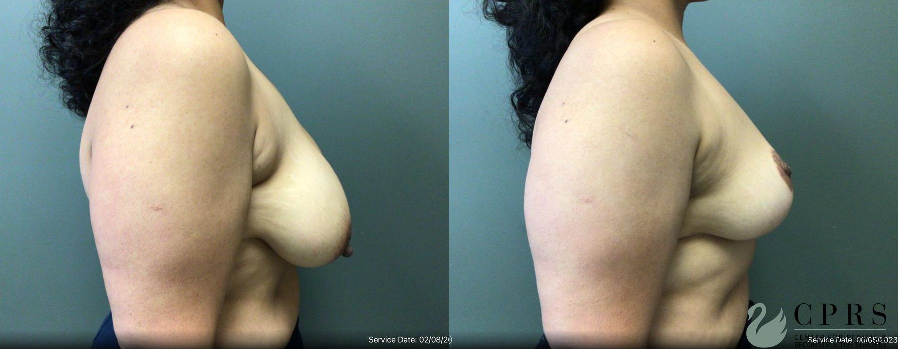 Before and after Breast Reduction case 19140 - Angle 2