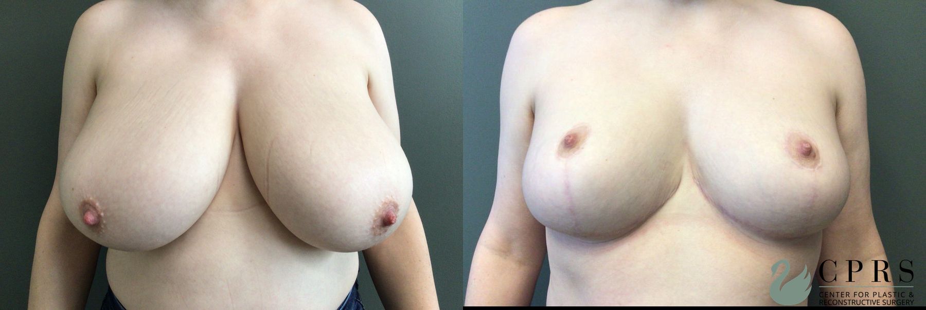 Before and after Breast Reduction case 43676