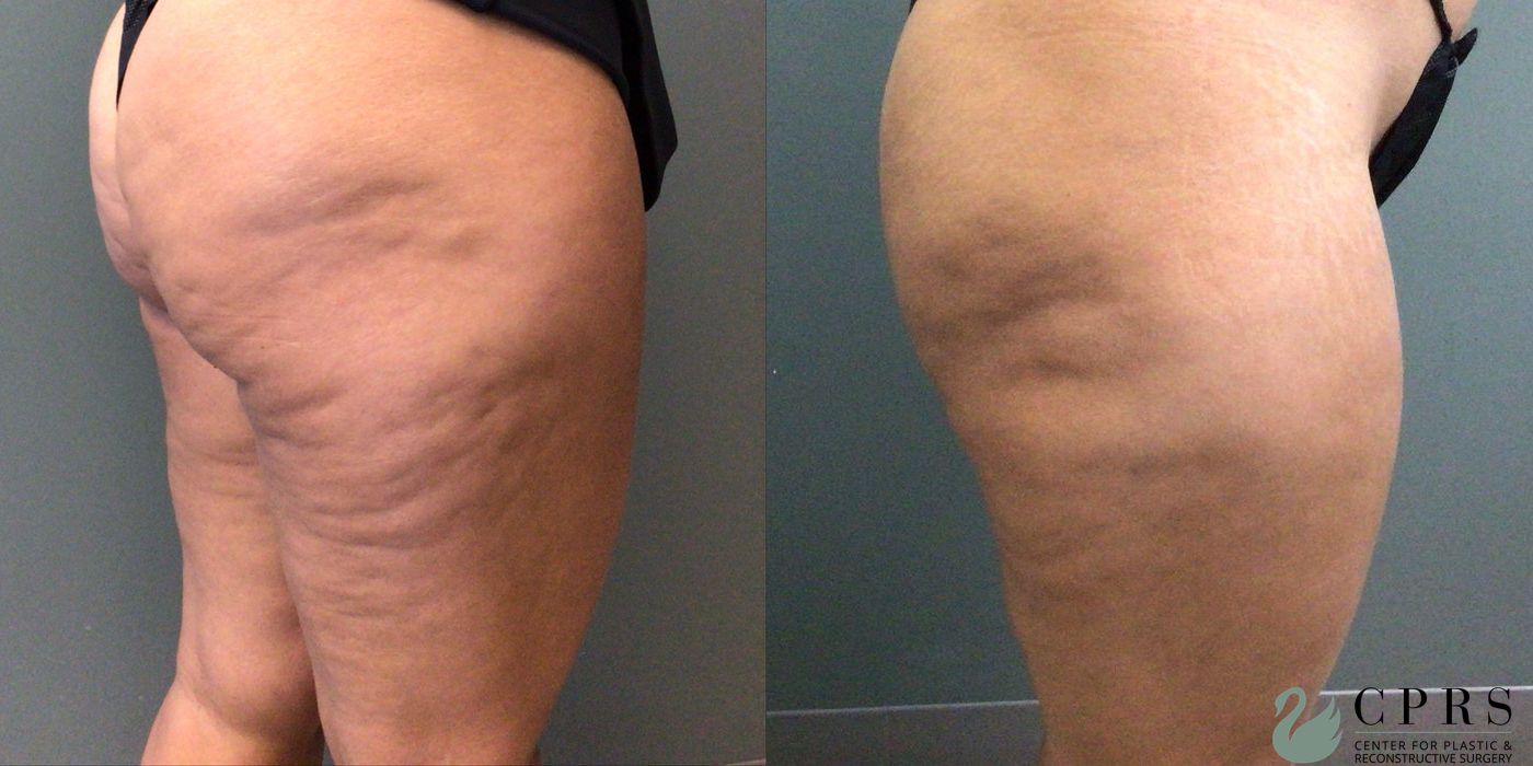 Before and after Cellulite Reduction case 21686 - Angle 2