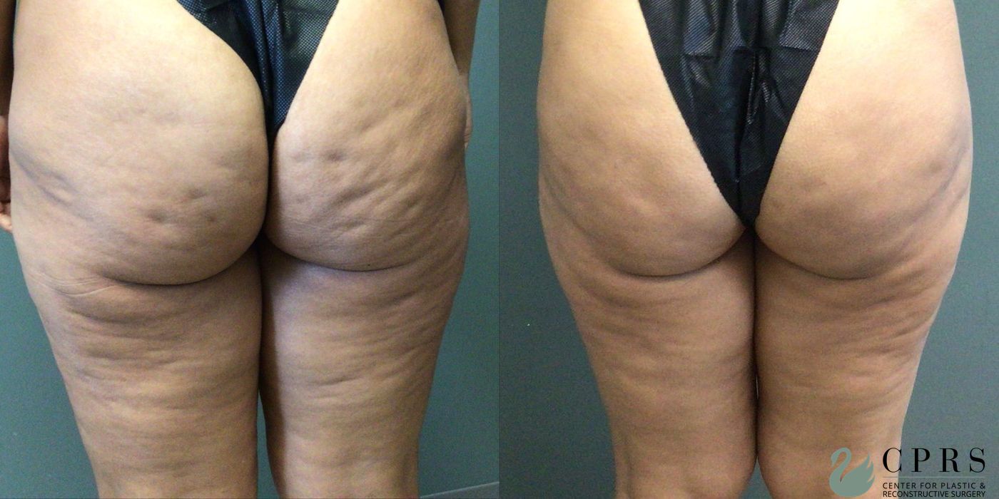 Before and after Cellulite Reduction case 21686