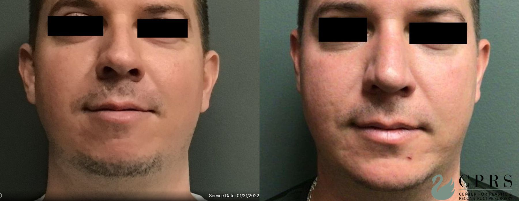 Before and after Chin Augmentation case 19035