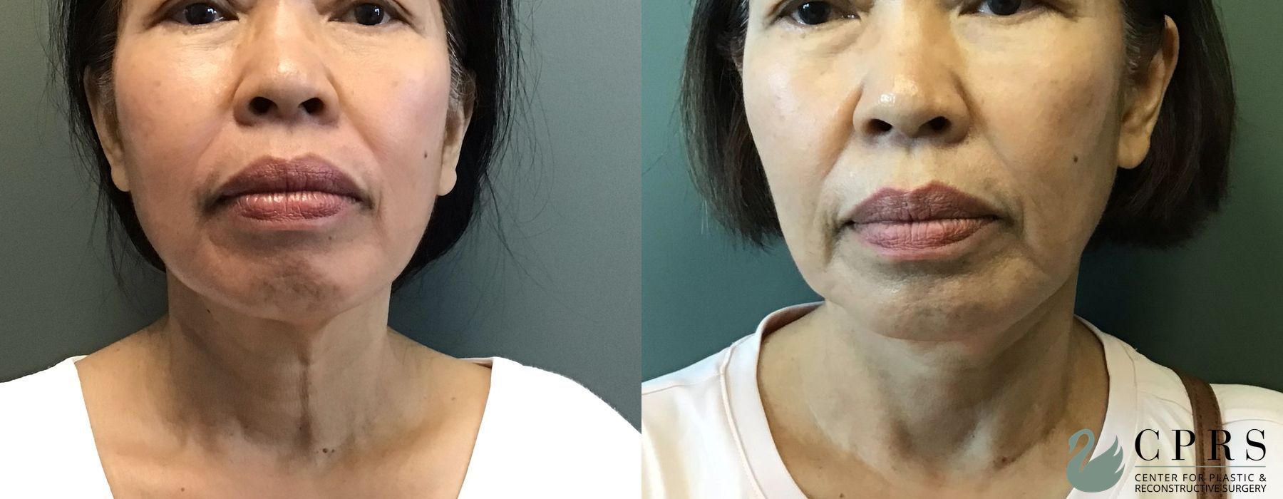 Before and after Chin Augmentation case 23844 - Angle 3