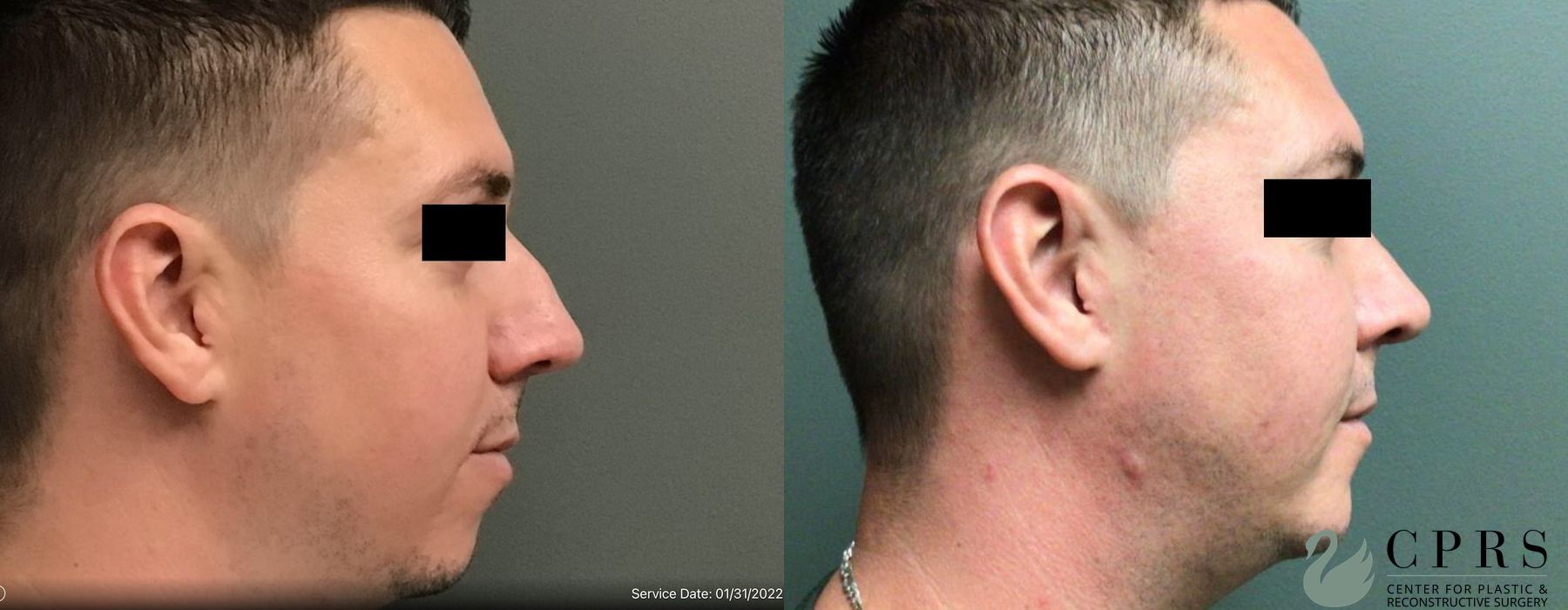 Before and after Chin Augmentation case 19035 - Angle 3