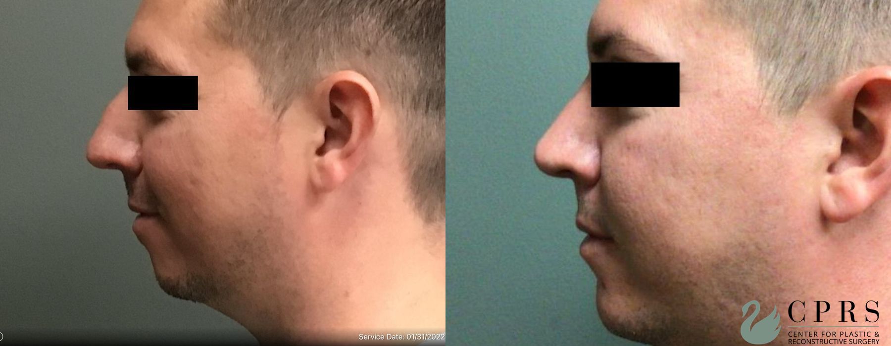Before and after Chin Augmentation case 19035 - Angle 2