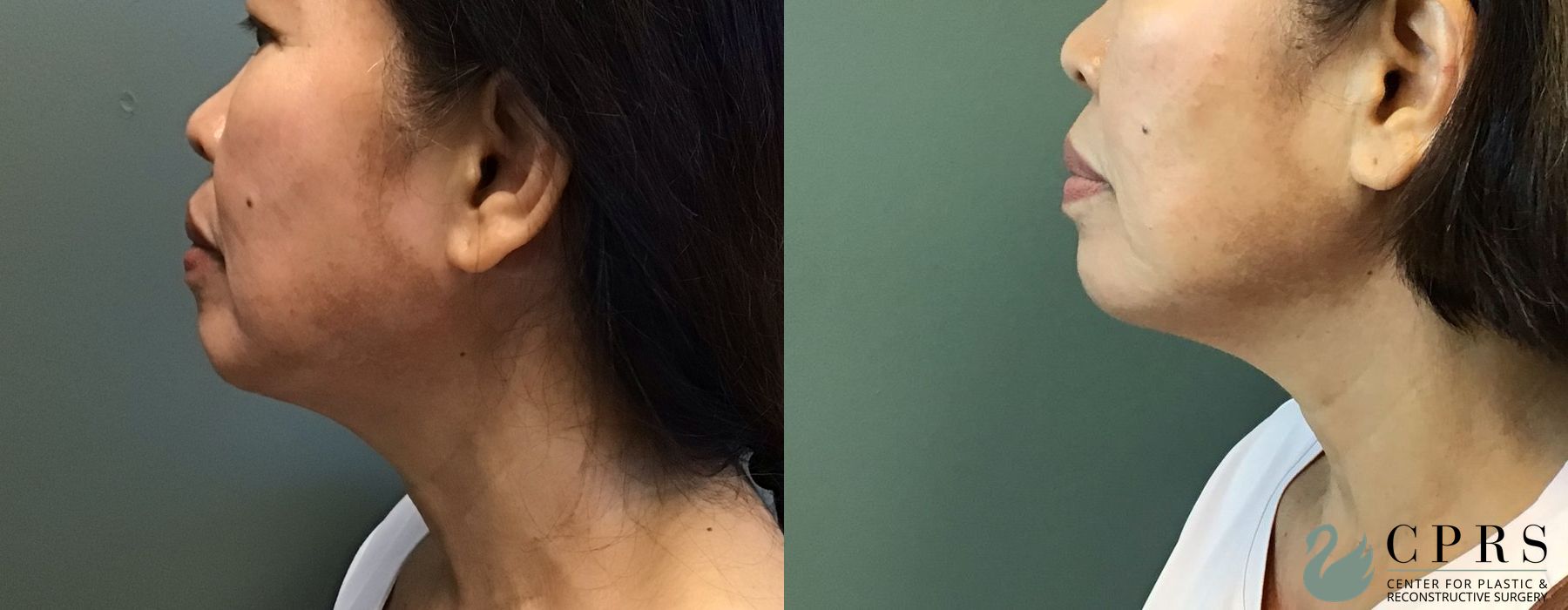Before and after Chin Augmentation case 23844 - Angle 2