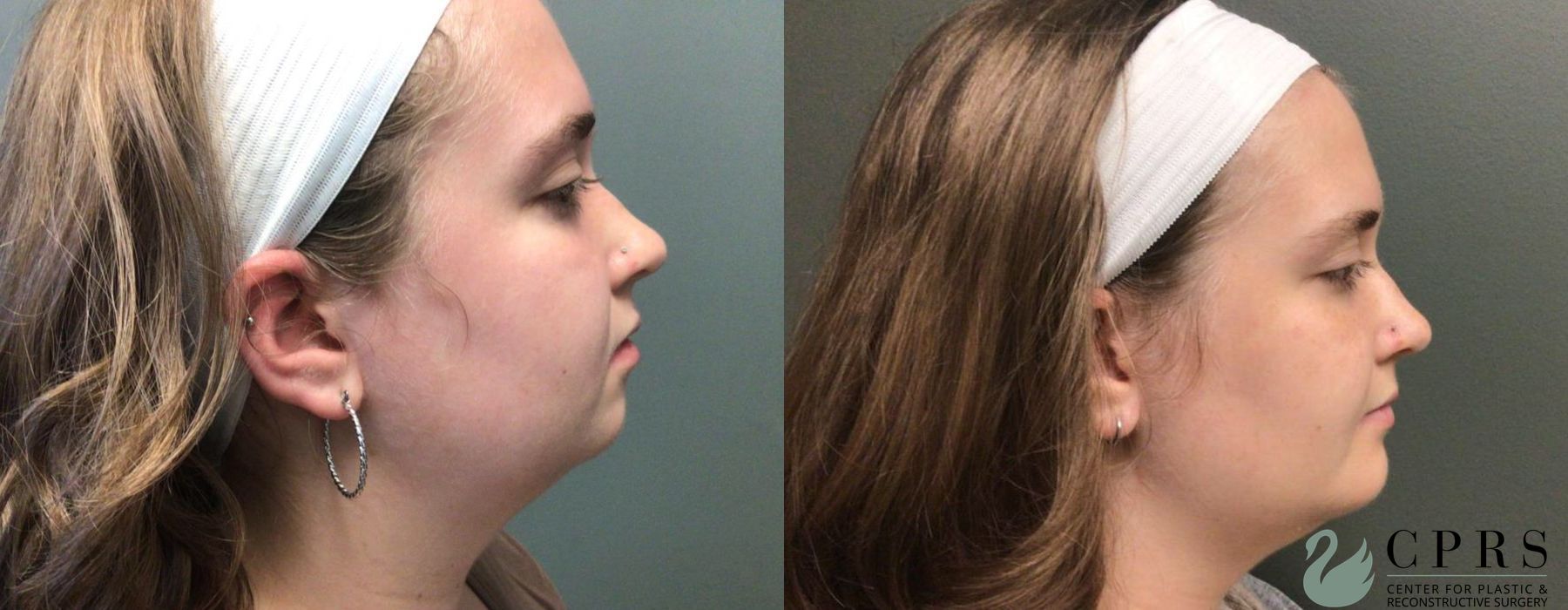 Before and after Chin Augmentation case 19123 - Angle 2
