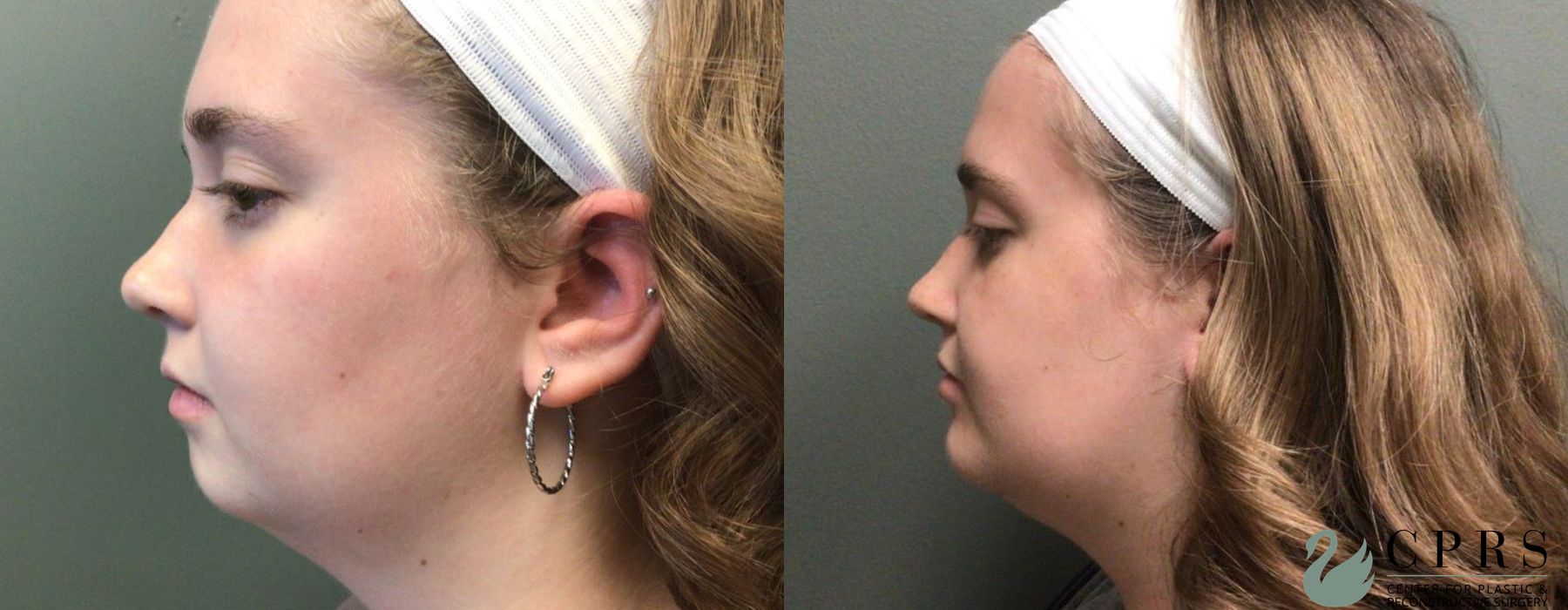 Before and after Chin Augmentation case 19123 - Angle 3